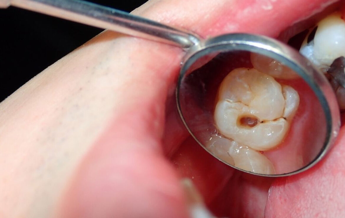 How does sugar damage your Teeth