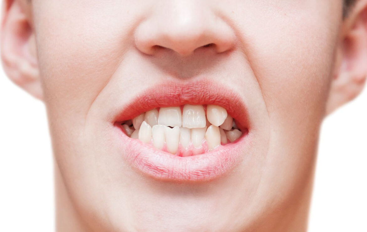 How to Fix Misaligned Teeth