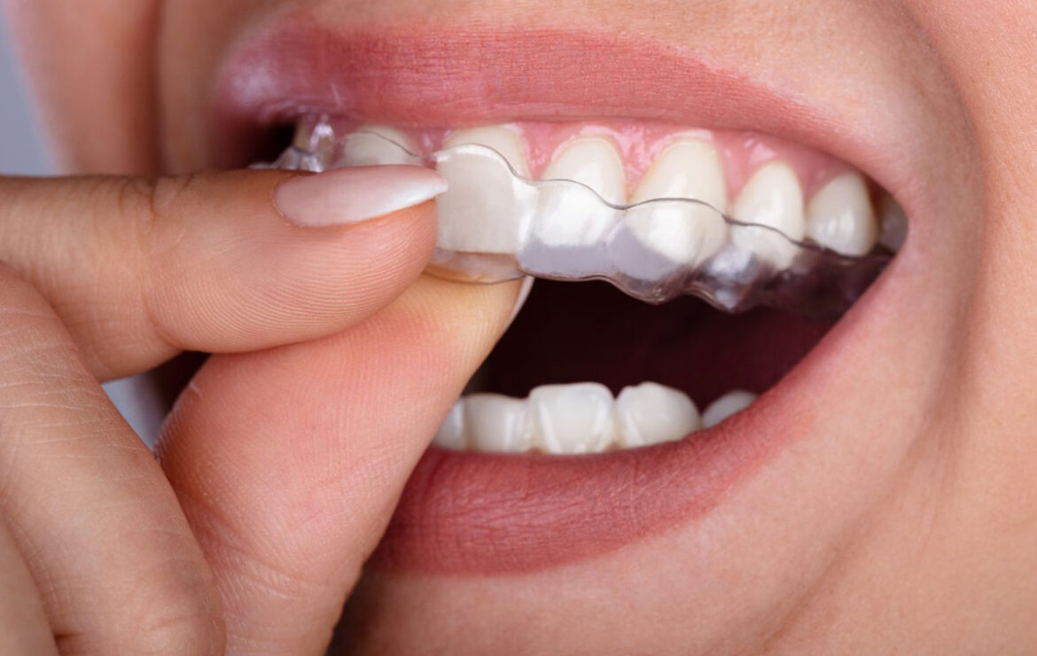 Invisible Aligners – A Clear Choice For A Confident Smile