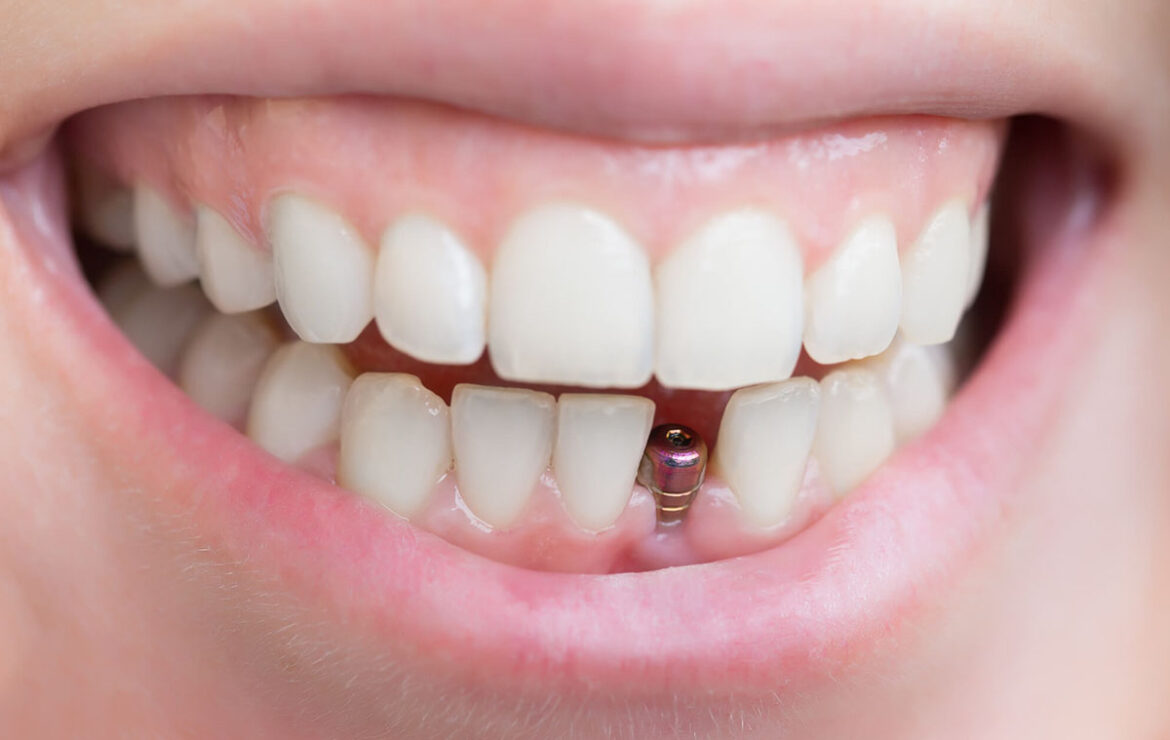 Top Warning Signs of Dental Implant Infection