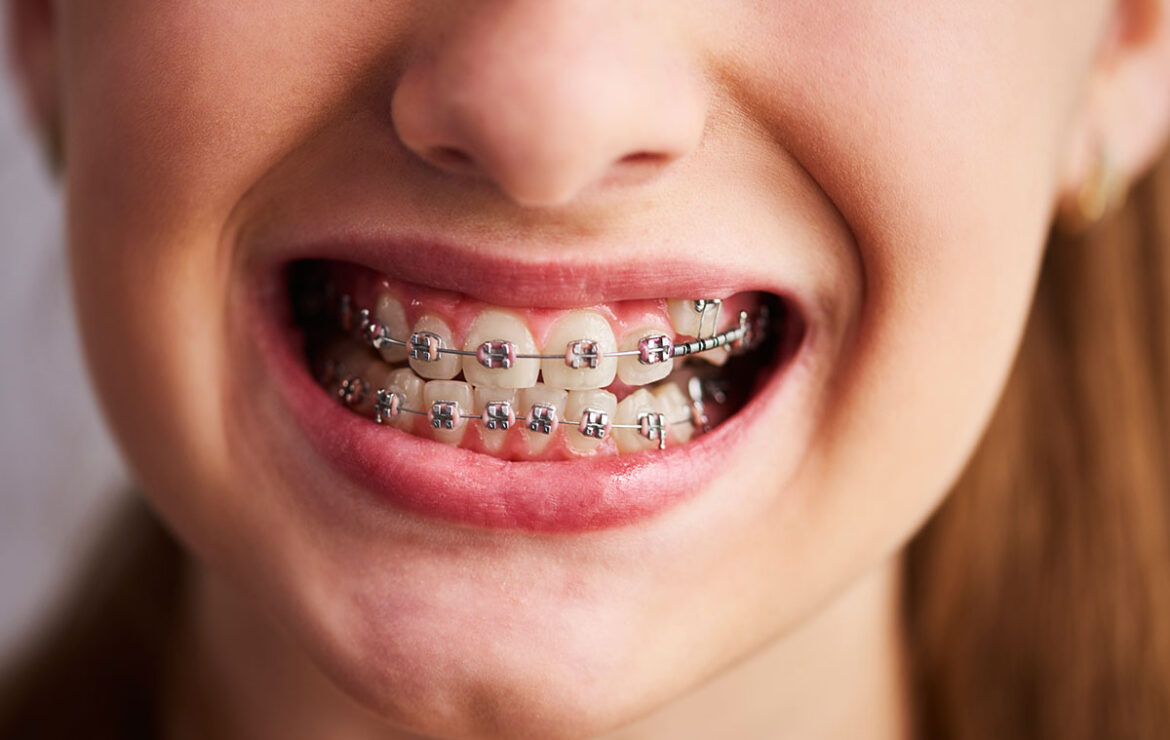 Types of Dental Braces – Which is Right for You