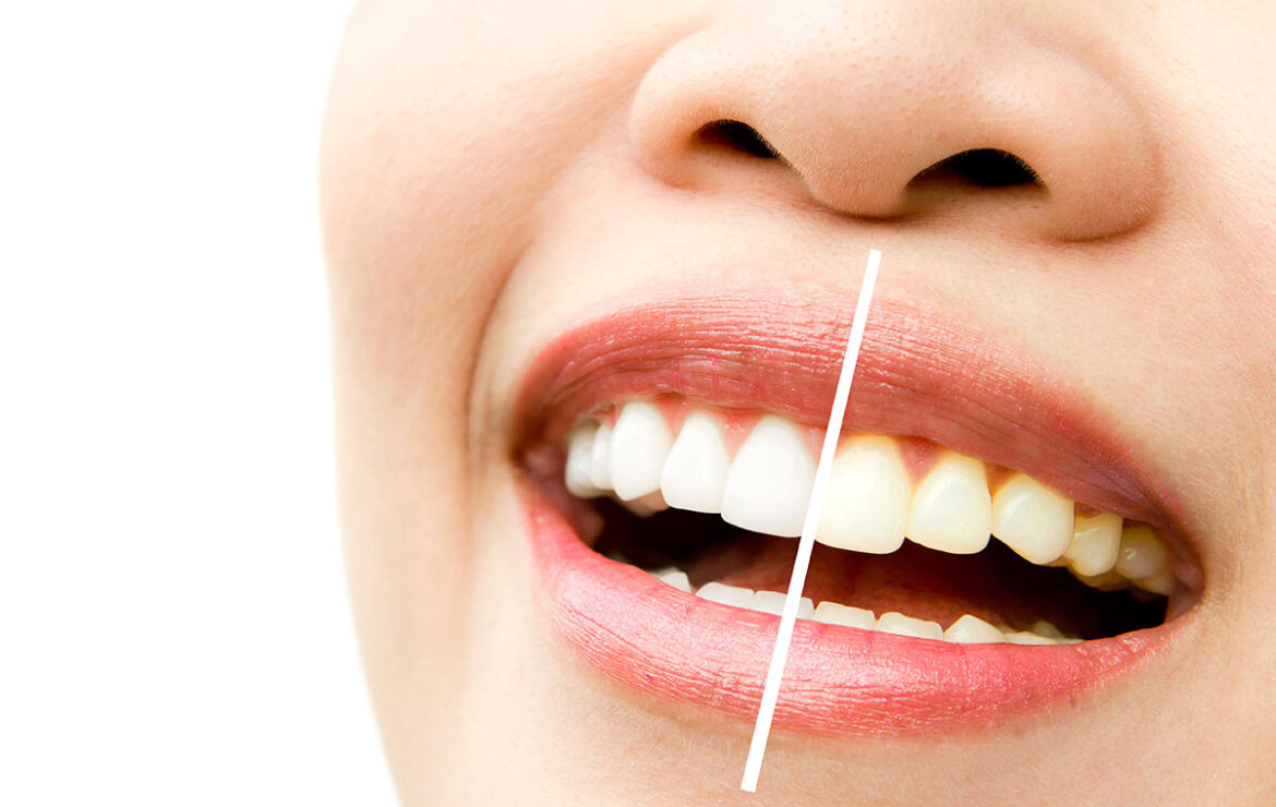 Yellow Teeth Here’s How to Whiten Yellow Teeth