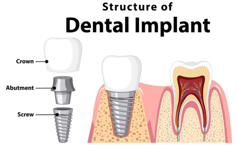 structure-of-dental-implant